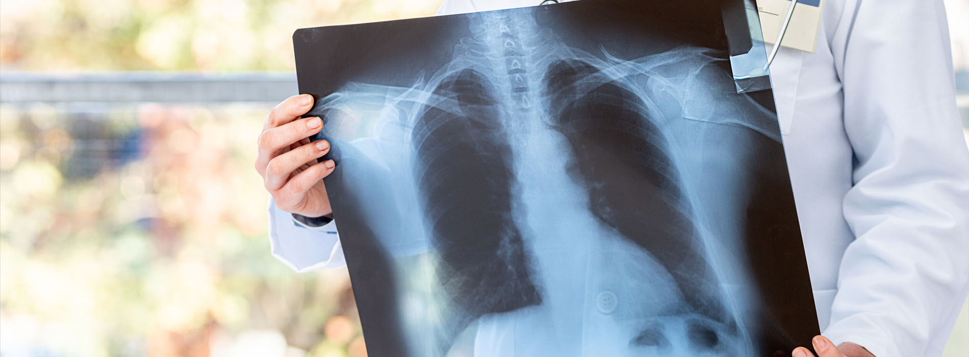 A medical professional holds up an X-ray film displaying a human chest with ribs and lungs clearly visible, set against a blurred background of a hospital setting.